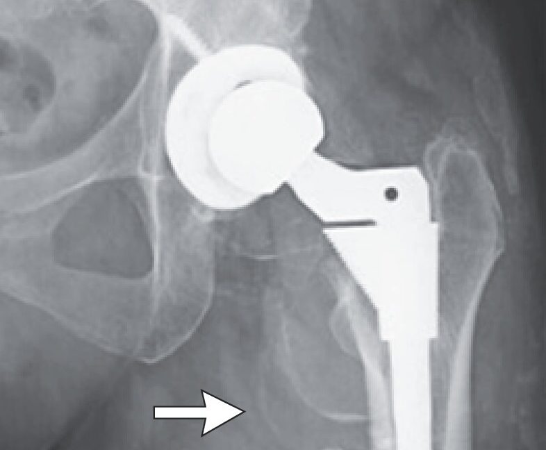 Woman’s hip replacement disintegrates, causing severe metal poisoning